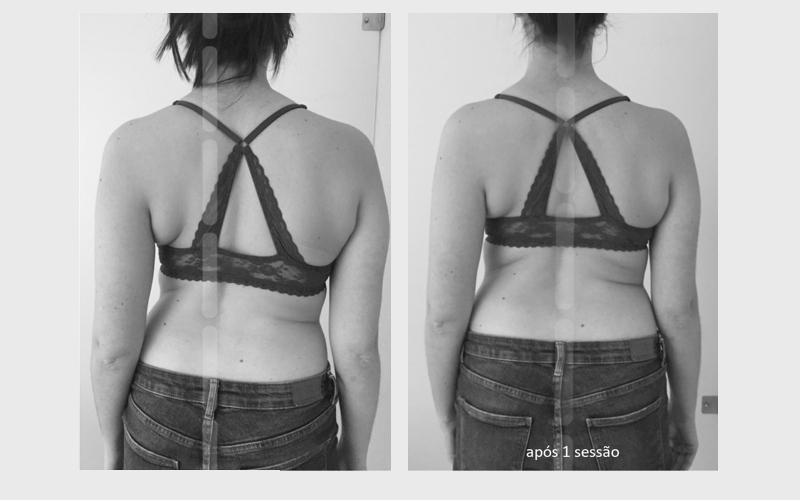 Imagem 3 sobre escoliose