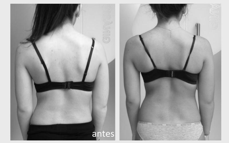 Imagem 5 sobre escoliose