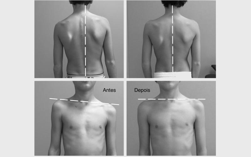 Imagem 7 sobre escoliose
